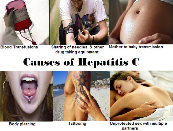 hepatitis_c_okai_